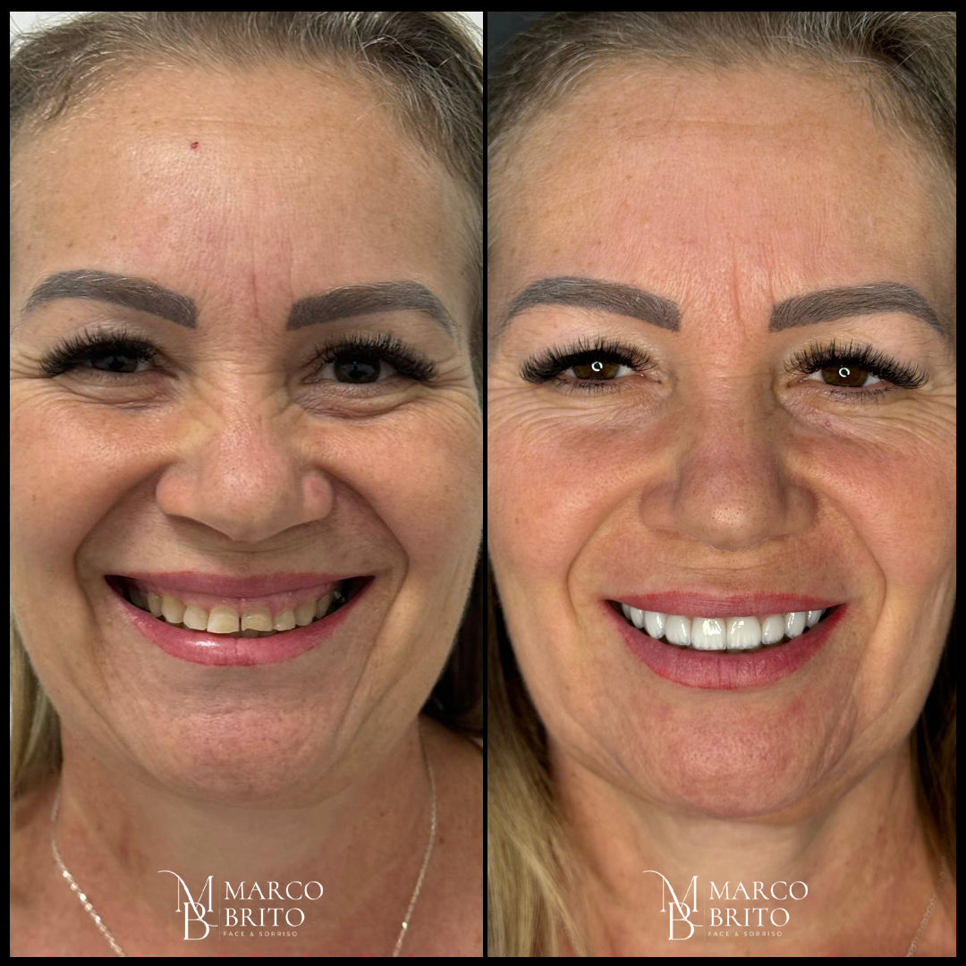 Antes e depois - Caso 1